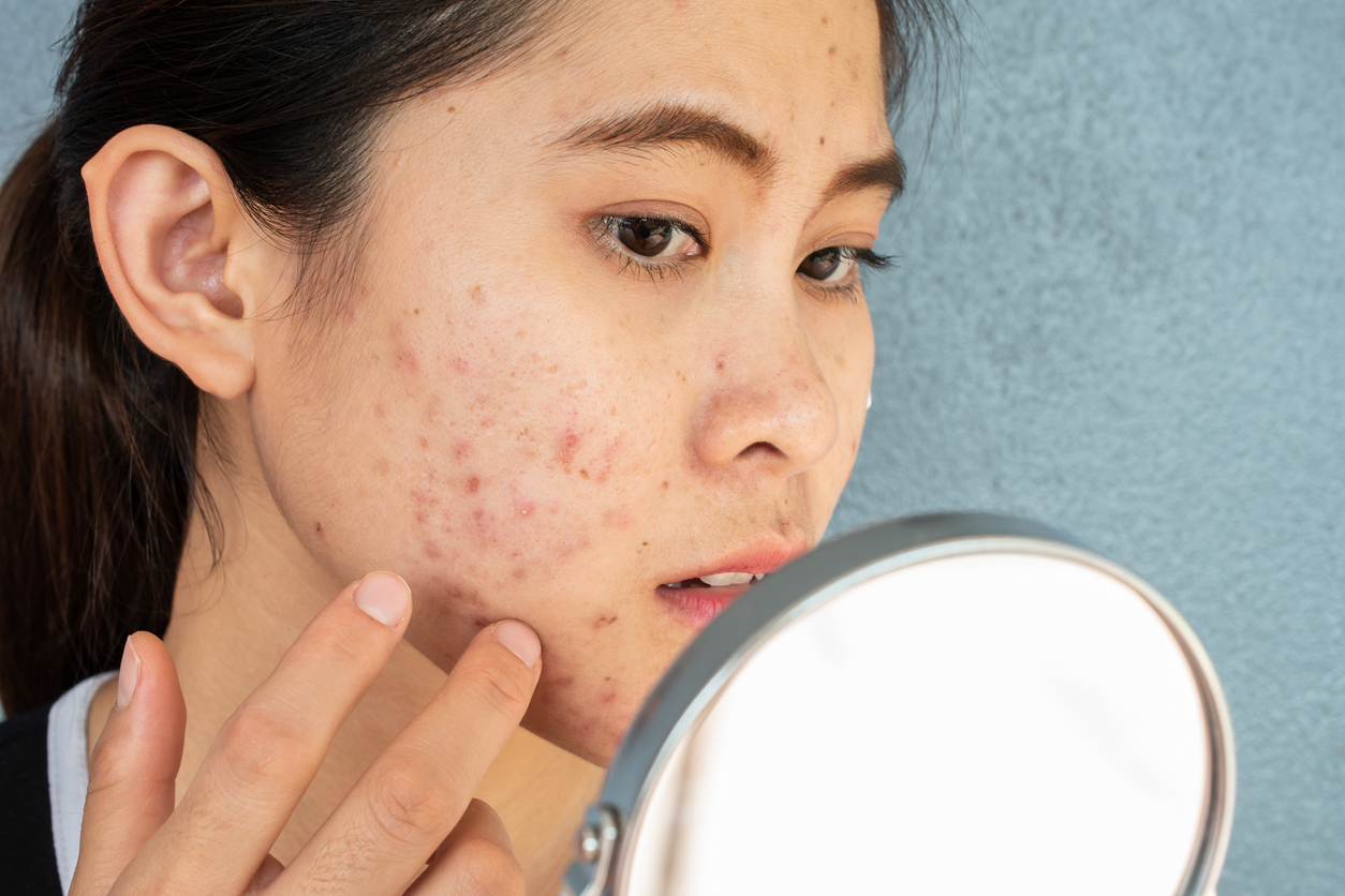 6 Types Of Acne And How Best To Treat Them Instantscripts 5639